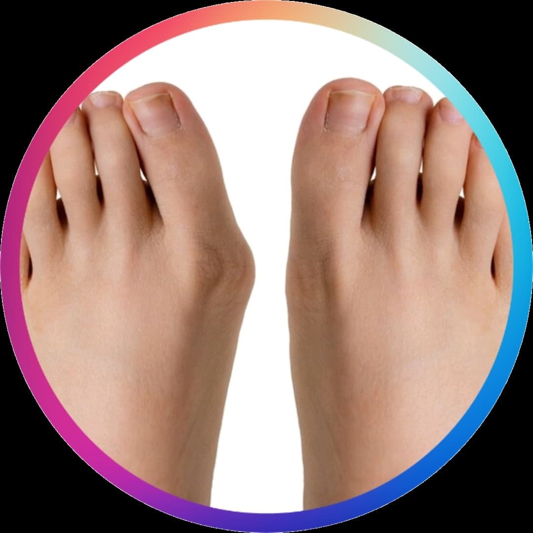HALLUX VALGUS